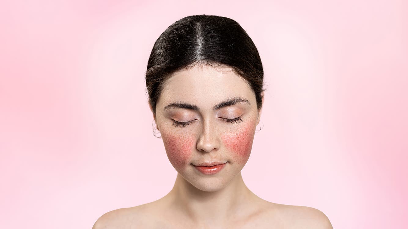 The Best Makeup for Rosacea