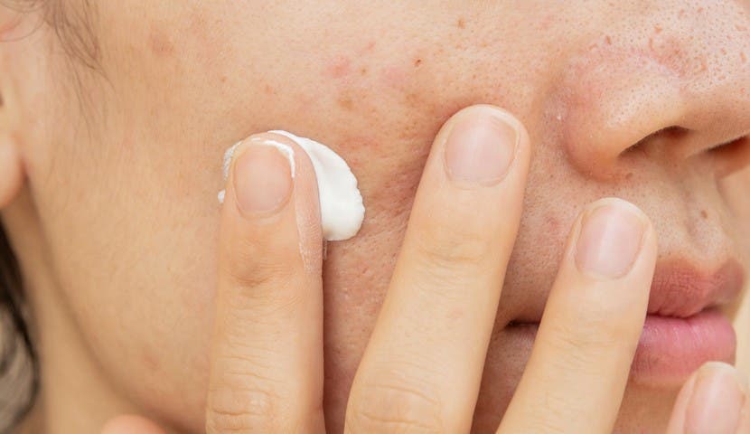 woman applying cream to dark spots on face