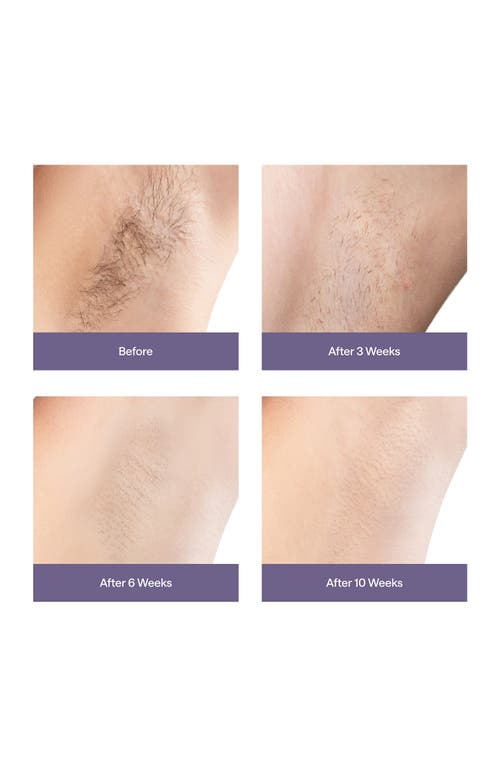 ULIKE ULIKE AIR3 IPL HAIR REMOVAL DEVICE