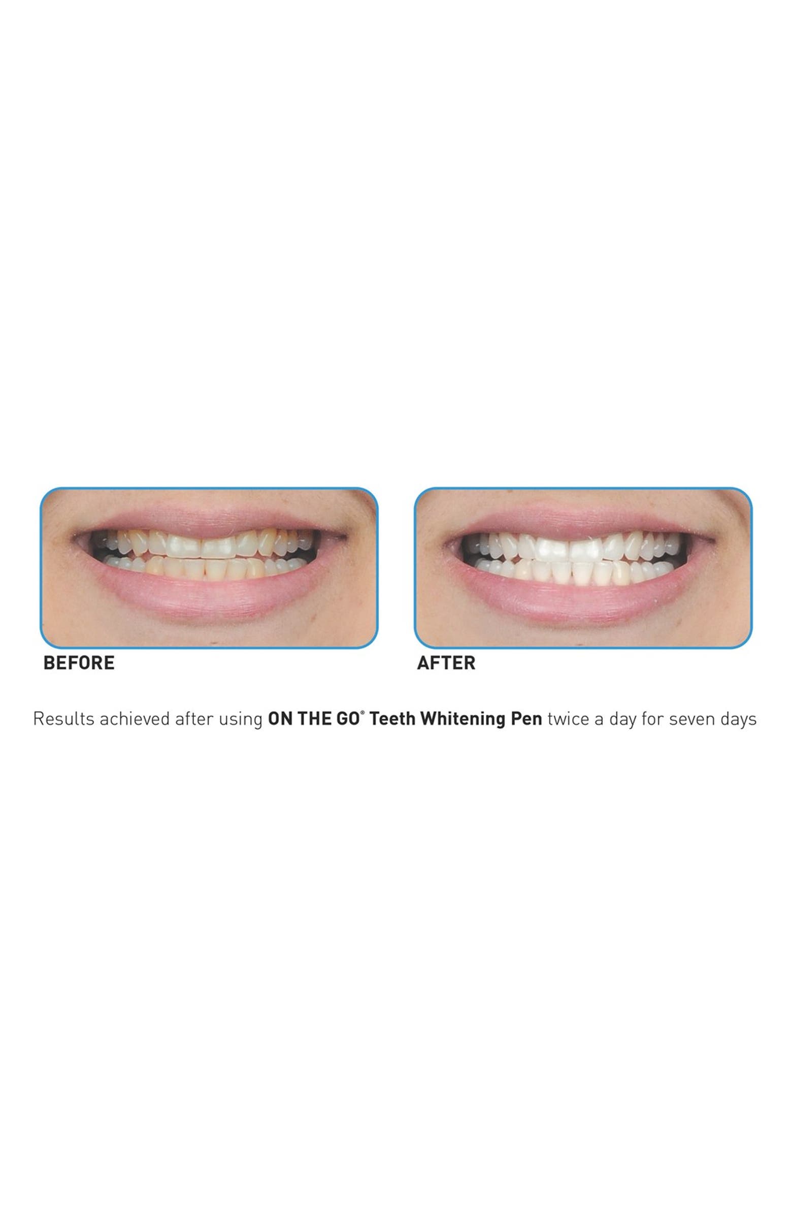 Go smile teeth whitening pen before and after Clearance
