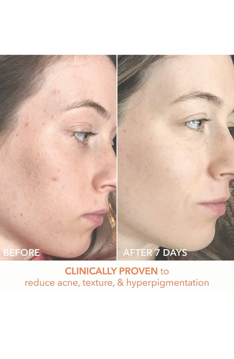 Dr. Dennis Gross Skincare Alpha Beta® Peel Original Formula 30