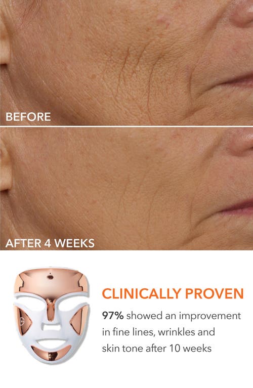 Dr Dennis Gross Skincare Dr. Dennis Gross Skincare Drx Spectralite™ Faceware Pro Led Light Therapy Device & Skin Care Set $64 In No Color