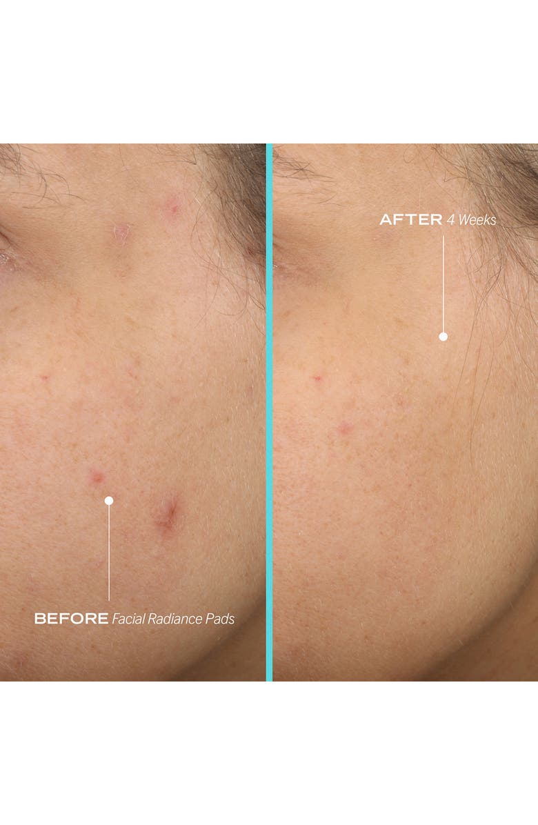 First Aid Beauty Facial Radiance Pads Nordstromrack