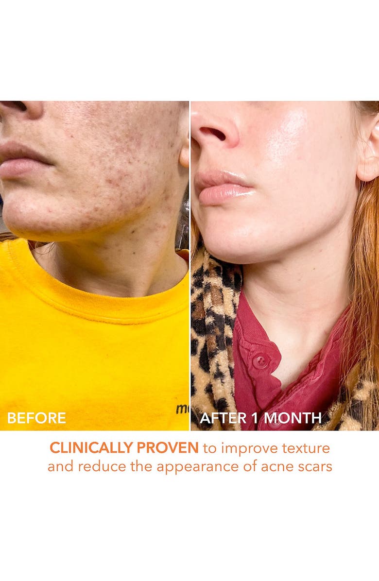 Dr. Dennis Gross Skincare Alpha Beta® Peel Original Formula 30