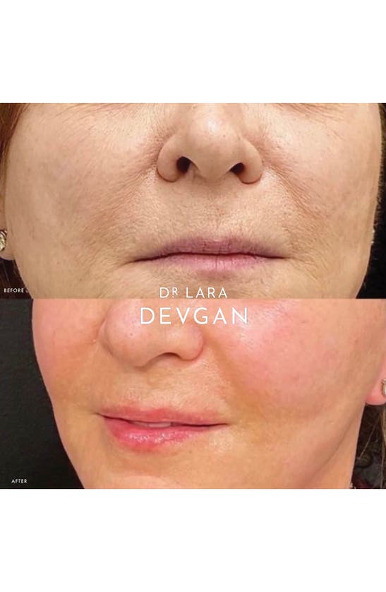 Dr Lara Devgan Dr. Lara Devgan Retinol + Bakchiol Serum In 2.5x