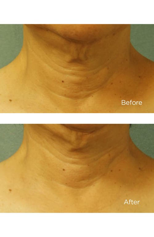 Perricone Md Cold Plasma+ Neck & Chest Cream Broad Spectrum Spf 25 In No Color