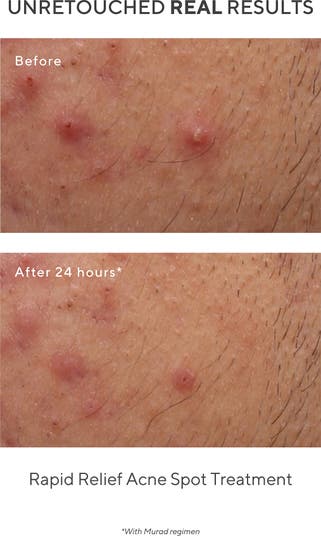 Rapid Relief Acne Spot Treatment - Murad