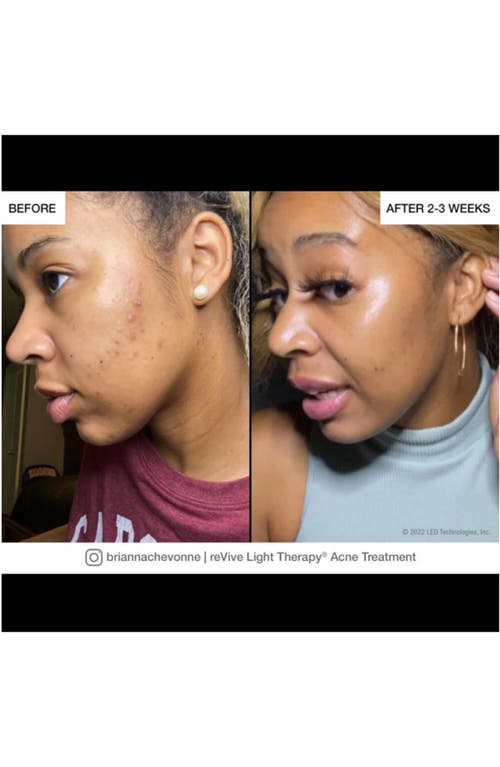 REVIVE LIGHT THERAPY REVIVE LIGHT THERAPY LUX COLLECTION SPOT ACNE TREATMENT DEVICE