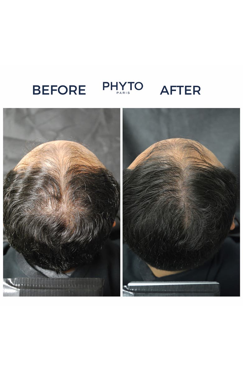PHYTO Lium 4 Chronic Thinning Hair Treatment, Alternate, color,
