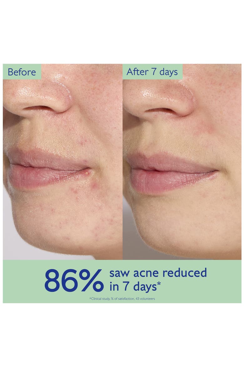 Vinopure Acne Serum, Alternate, color, NONE