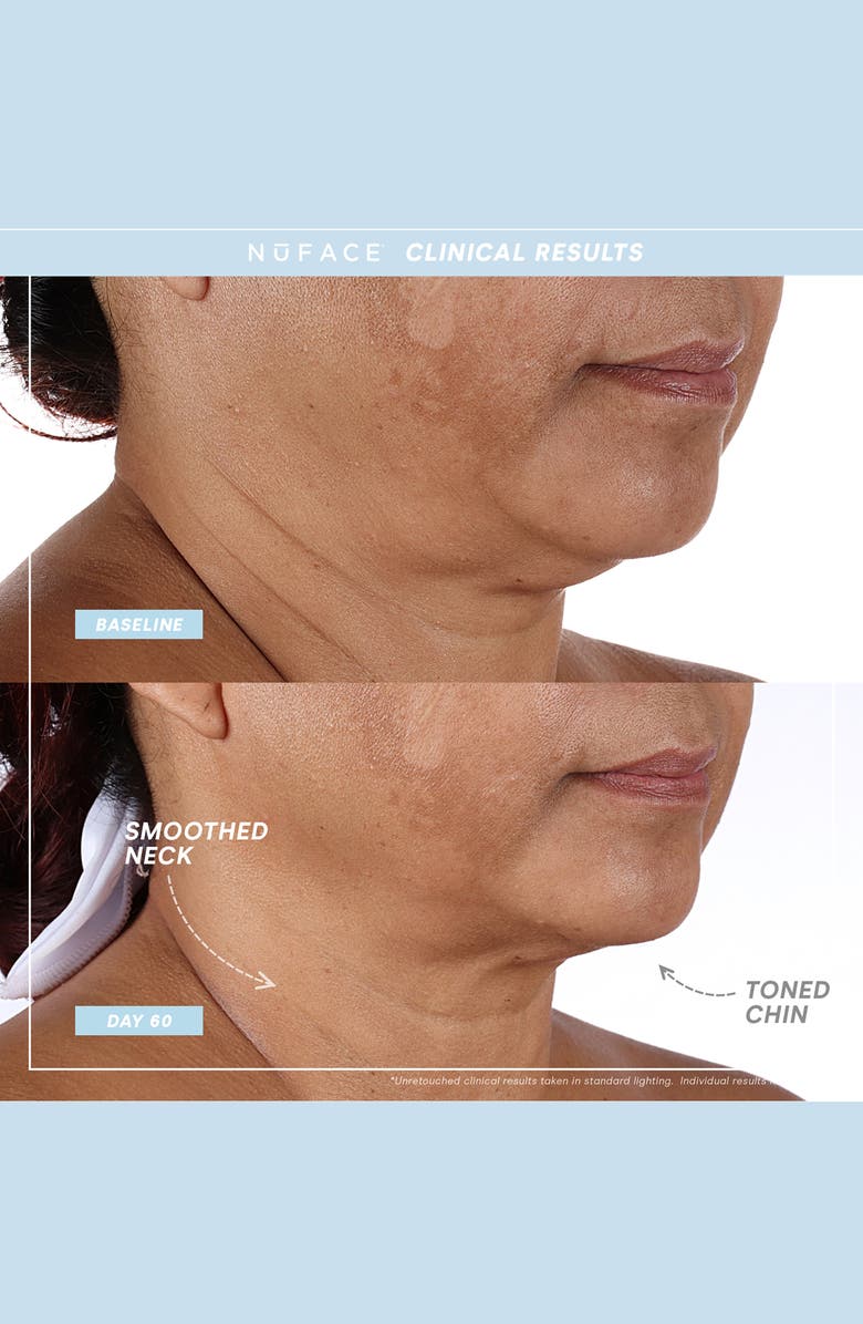 NuFACE<sup>®</sup> TRINITY+ Supercharged Skin Care Routine Set (Limited Edition) USD $509 Value, Alternate, color, 