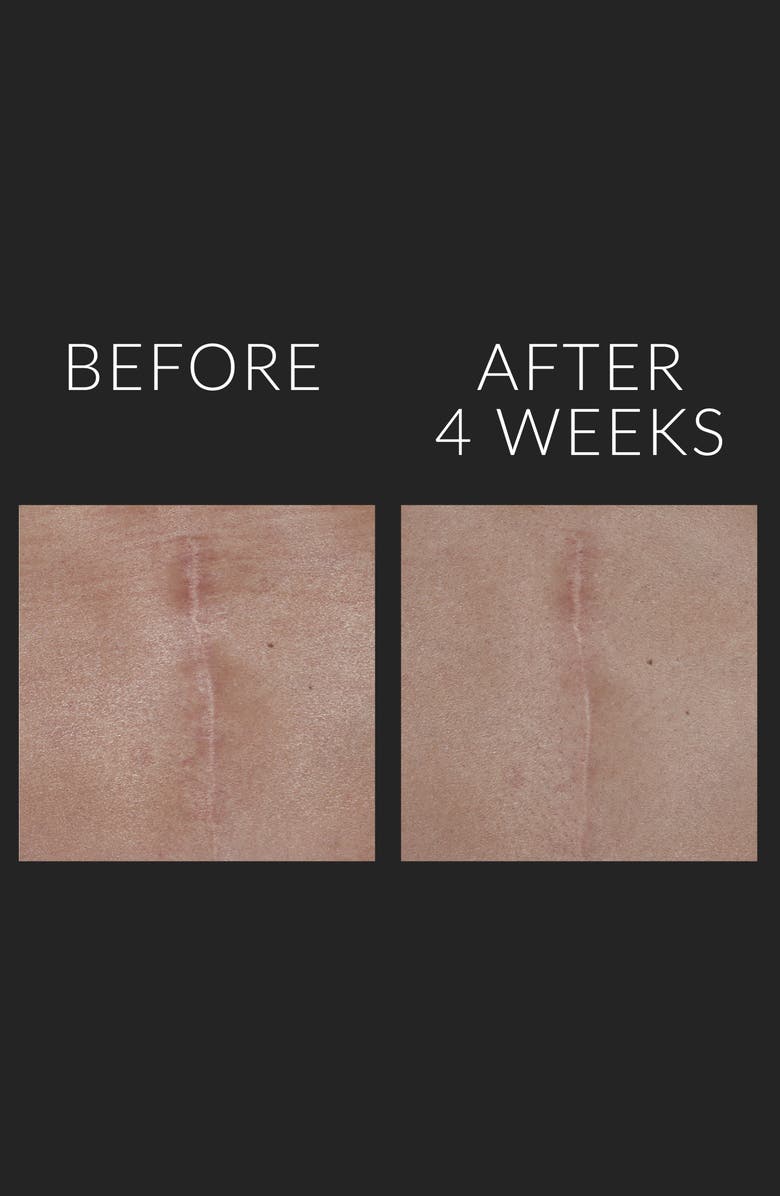 Kate Somerville<sup>®</sup> 'D-Scar' Scar Diminishing Serum, Alternate, color, 