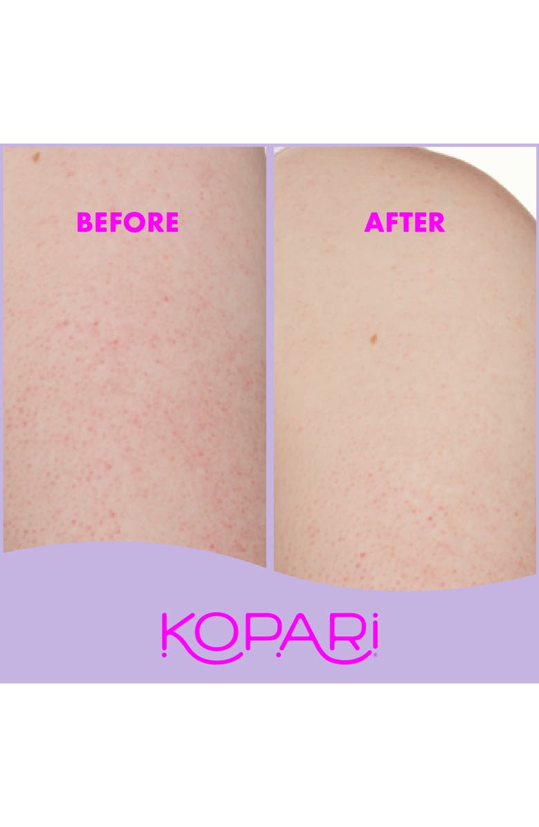 Kopari KP Body Bumps Be Gone with 10% AHA Exfoliator, Alternate, color,