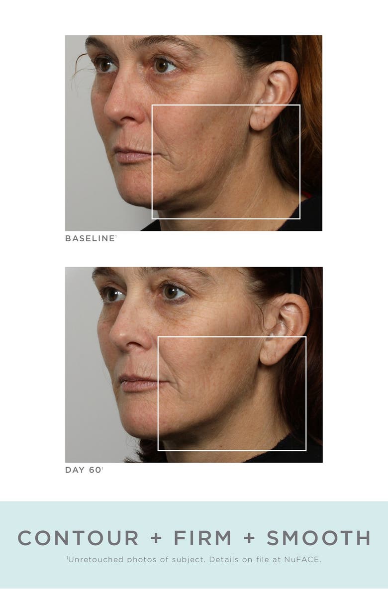 NuFACE<sup>®</sup> NuFace Refreshed Trinity Kit - White - Refurbished, Alternate, color, 