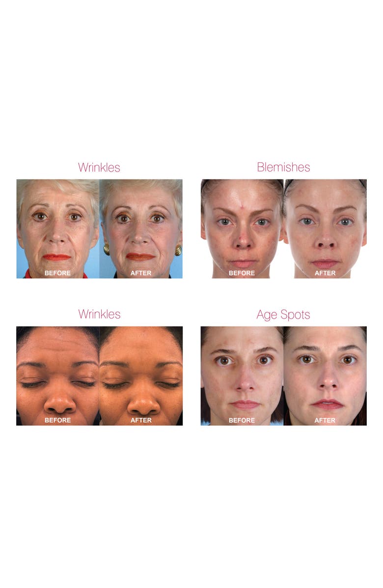 PMD Personal Microderm Pro Exfoliation Device, Alternate, color, White