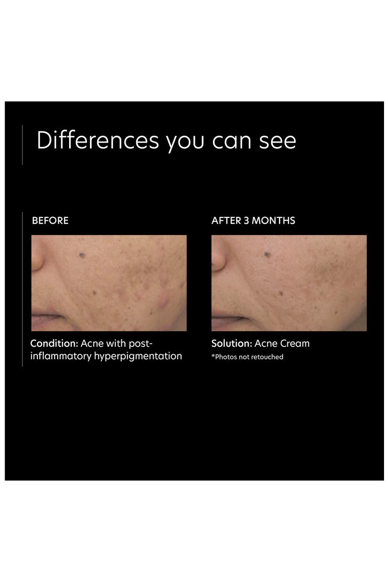 Acne Cream Spot Treatment, Alternate, color, NO COLOR