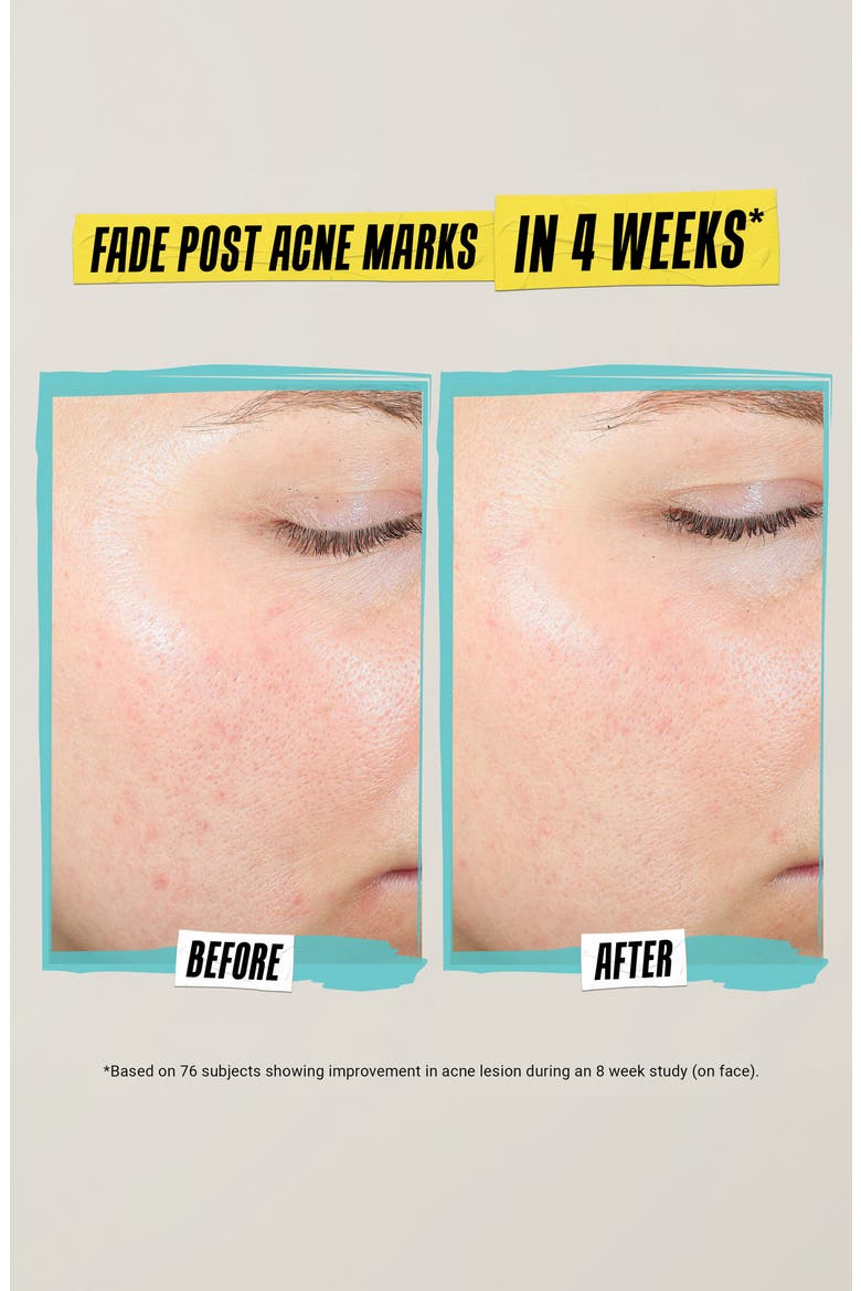 Expertly Clear Acne-Treating & Preventing Lotion, Alternate, color, NO COLOR