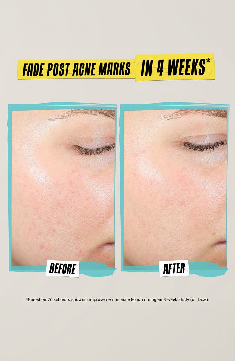 Kiehl's Since 1851 Expertly Clear Acne-Treating & Preventing Lotion, Alternate, color, 