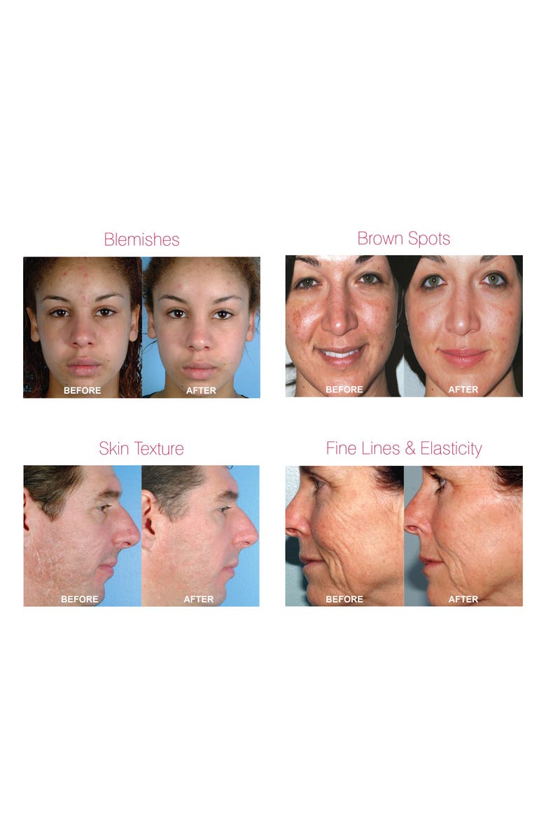 PMD Personal Microderm Pro Exfoliation Device, Alternate, color, White