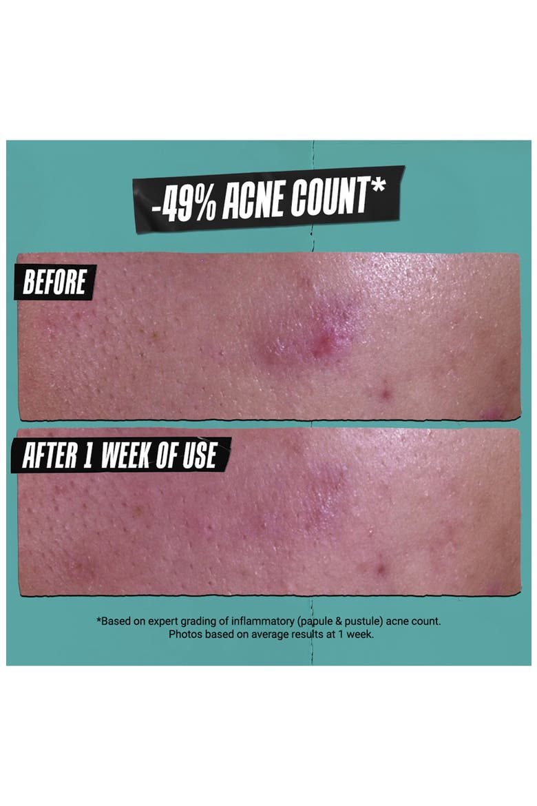 Gently Effective Acne-Treating Cleansing Paste, Alternate, color, NO COLOR