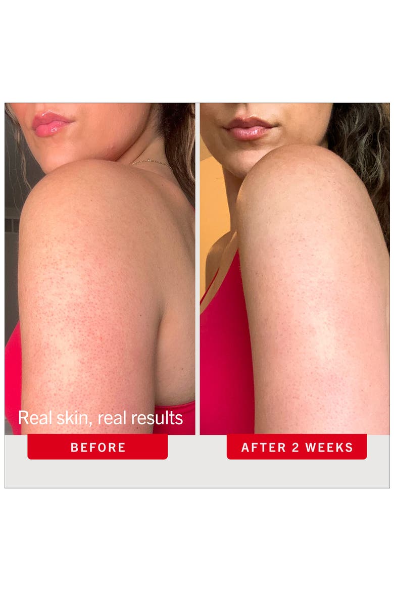KP Bump Eraser Body Scrub with 10% AHA, Alternate, color, NO COLOR