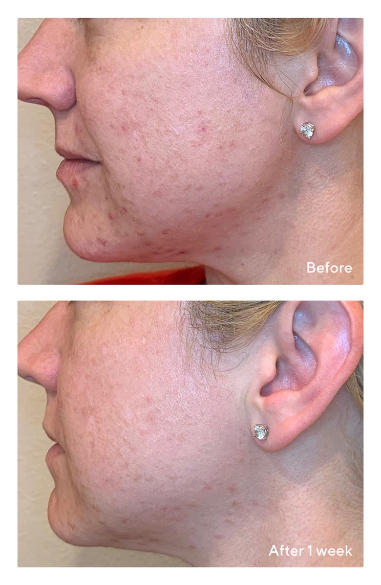 Murad<sup>®</sup> Daily Clarifying Peel Toner, Alternate, color,