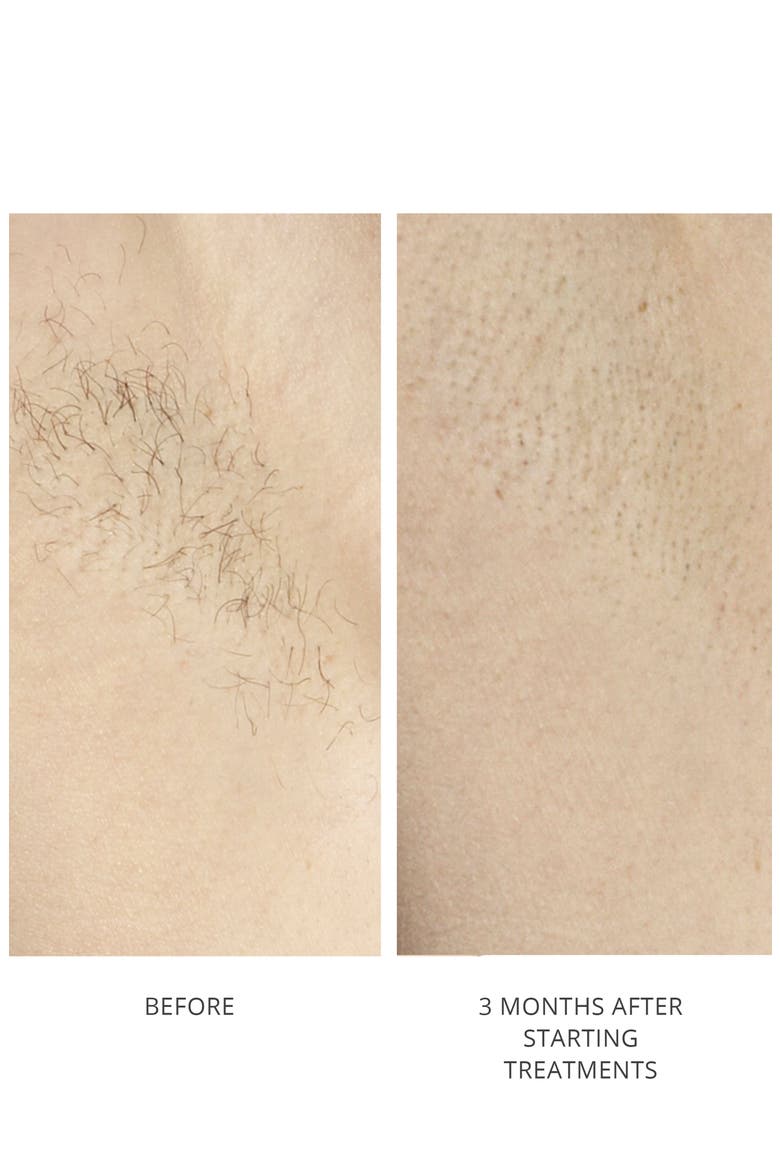 Hair Removal Laser 4X, Alternate, color, FUCHSIA