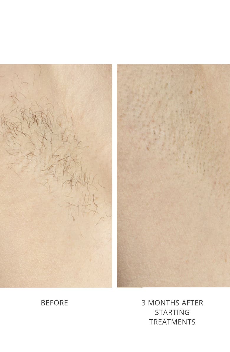 TRIA Beauty Hair Removal Laser 4X, Alternate, color, 