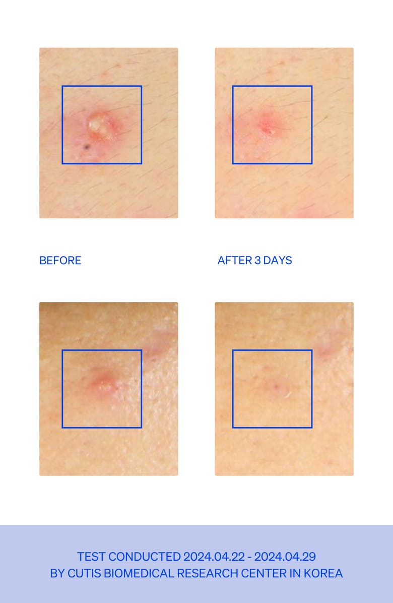 KNEMO Right Away Thincognito Spot Patches, Alternate, color, Blue