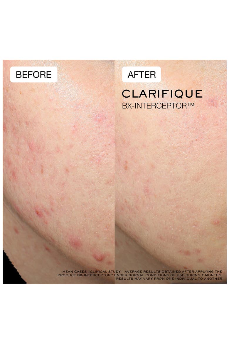 Clarifique Bx-Interceptor Acne Treatment with Glycolic & Salicylic Acid, Alternate, color, NO COLOR