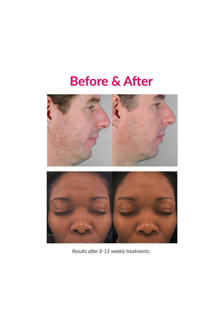 Personal Microderm Elite Pro Exfoliation Device, Alternate, color, SKY