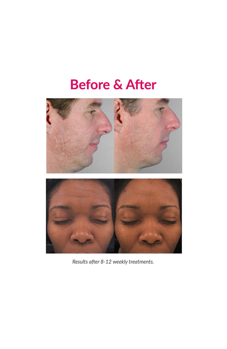 PMD Personal Microderm Elite Pro Exfoliation Device, Alternate, color, London Fog