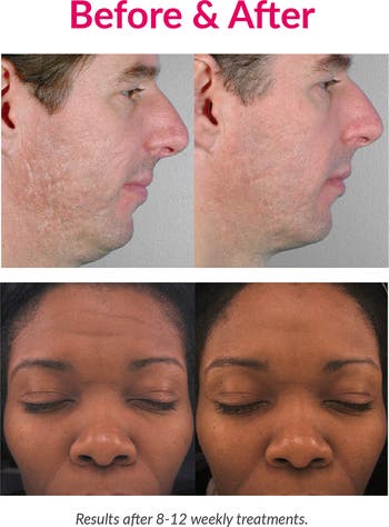 Personal Microderm Elite Pro Exfoliation Device