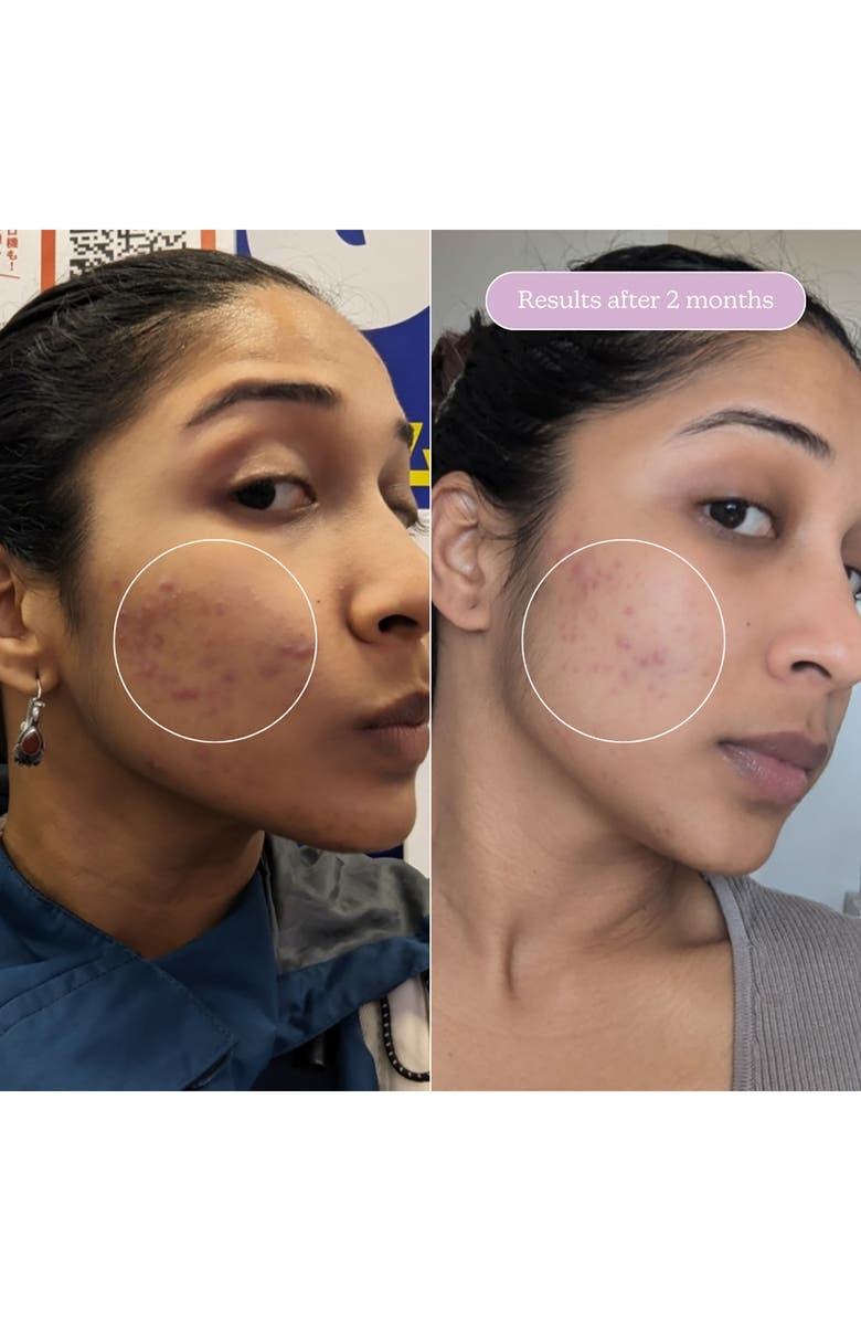 BLUME Milky Fade Spot & Scar Fade Serum, Alternate, color, 