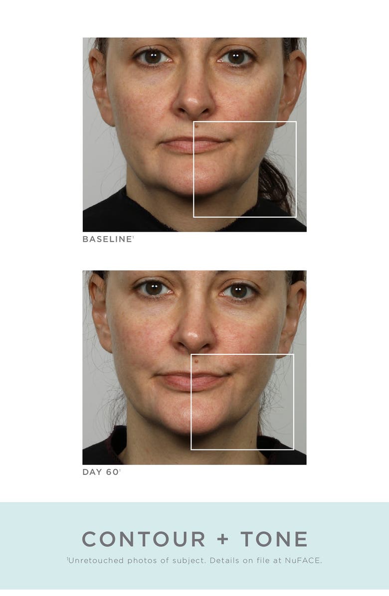 NuFACE<sup>®</sup> NuFace Refreshed Trinity Kit - White - Refurbished, Alternate, color, 