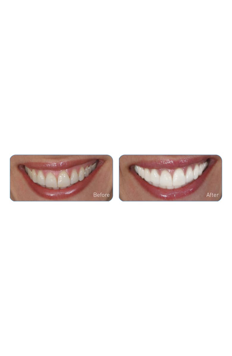 GO SMiLE<sup>®</sup> Dental Pro On-the-Go Sonic Blue Teeth Whitening System, Alternate, color,