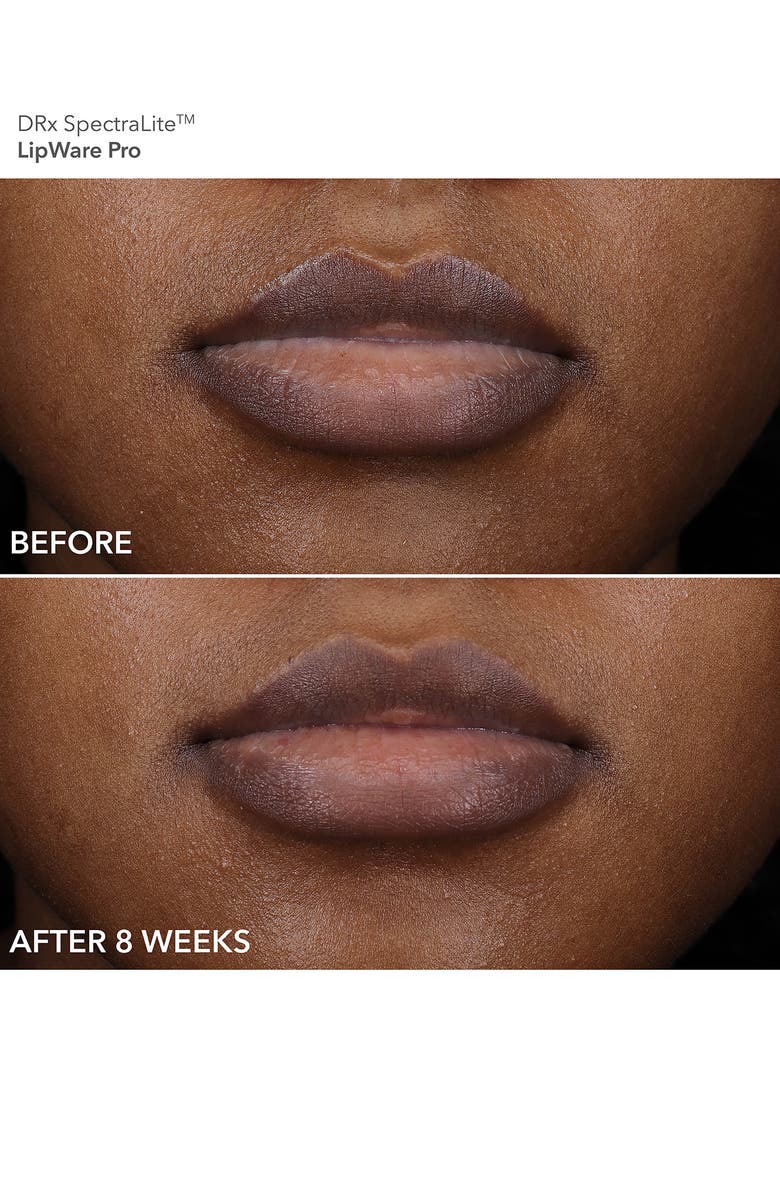 Dr. Dennis Gross Skincare Plumped Perfection Drx. SpectraLite LipWare Pro Set (LImited Edition) $223 Value, Alternate, color,