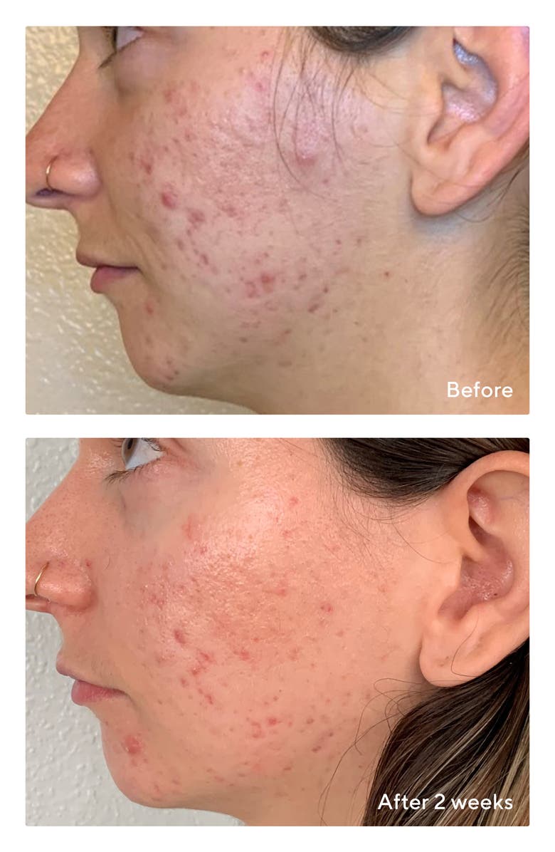 Murad<sup>®</sup> Daily Clarifying Peel Toner, Alternate, color,