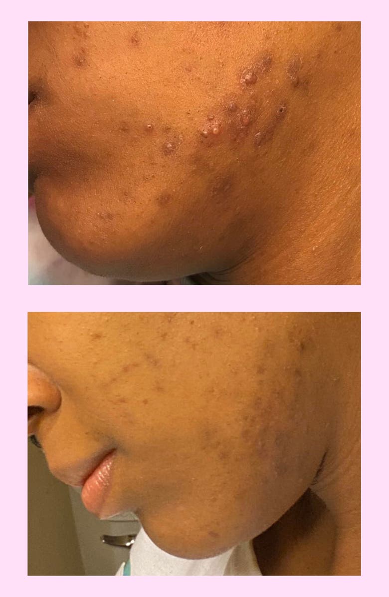 ROSEN Break-Out Spot Treatment, Alternate, color,