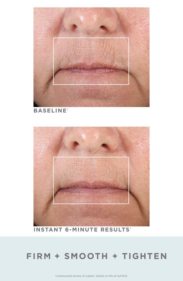 NuFACE<sup>®</sup> FIX Line Smoothing Device Kit, Alternate, color, 