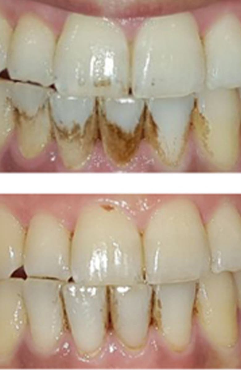 Silk'n Toothwave Dental Toothbrush, Alternate, color,