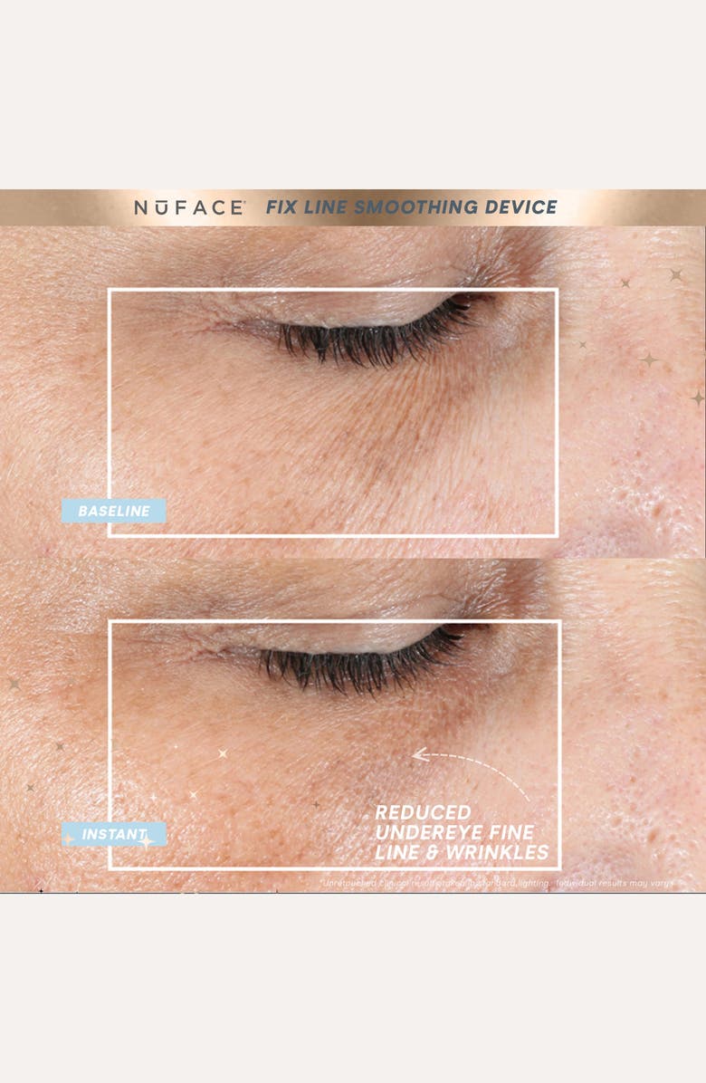 NuFACE<sup>®</sup> FIX<sup>®</sup> Line Smoothing Regimen Set USD $208 Value, Alternate, color,