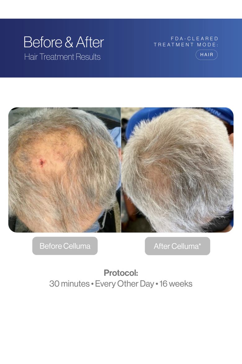 RESTORE Red Light Hair Therapy, Alternate, color, Blue