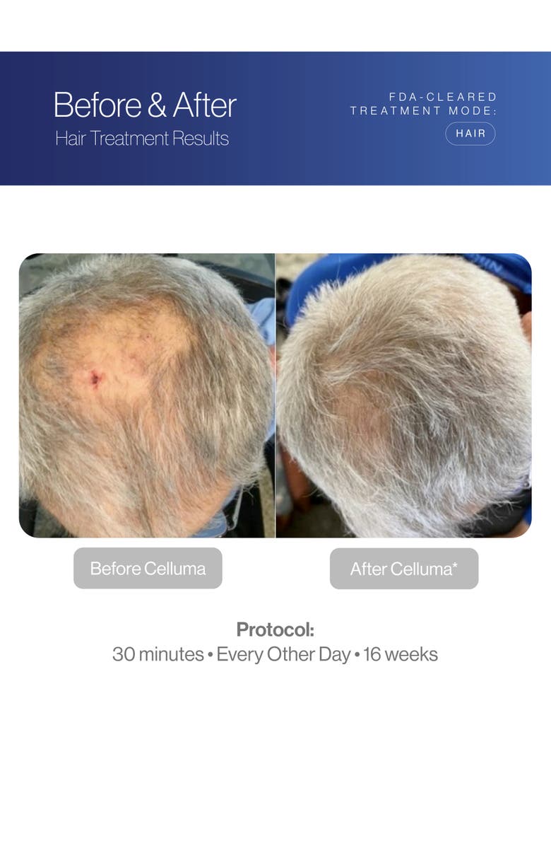 Celluma RESTORE Red Light Hair Therapy, Alternate, color, Blue