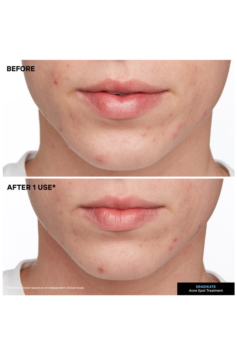 EradiKate® Acne Treatment, Alternate, color, NO COLOR