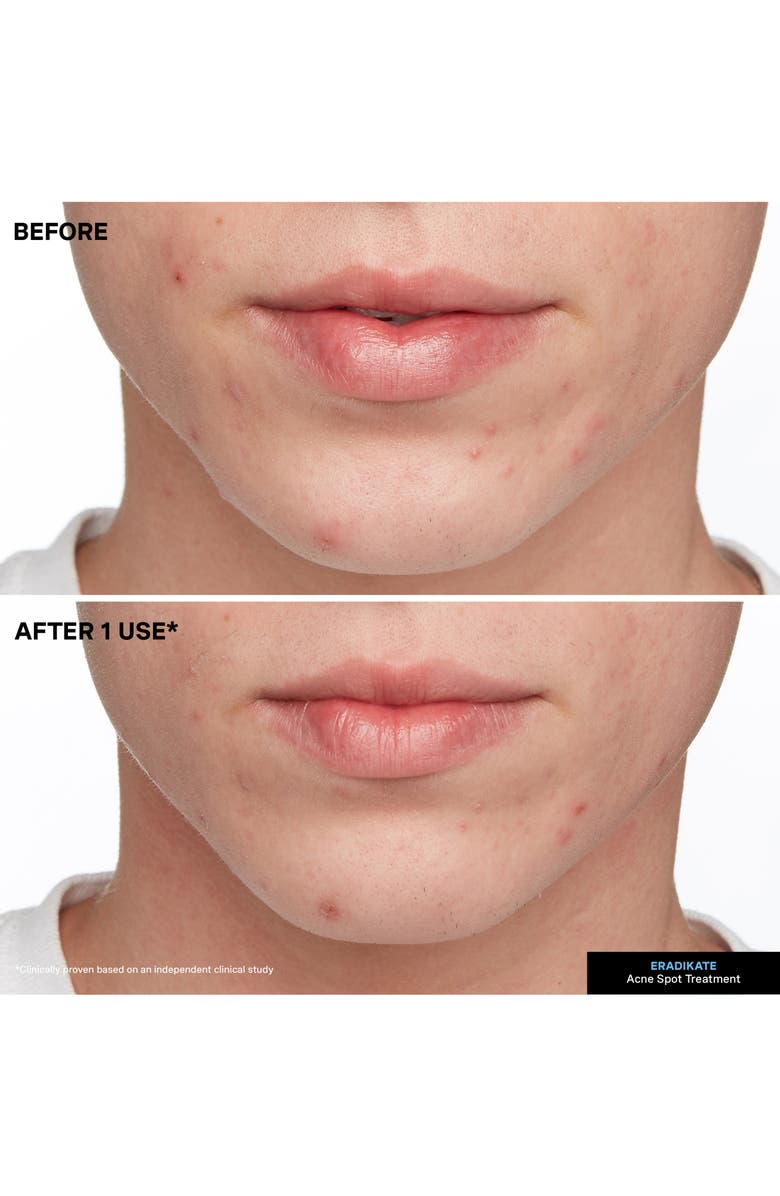 Kate Somerville<sup>®</sup> EradiKate<sup>®</sup> Acne Treatment, Alternate, color, 