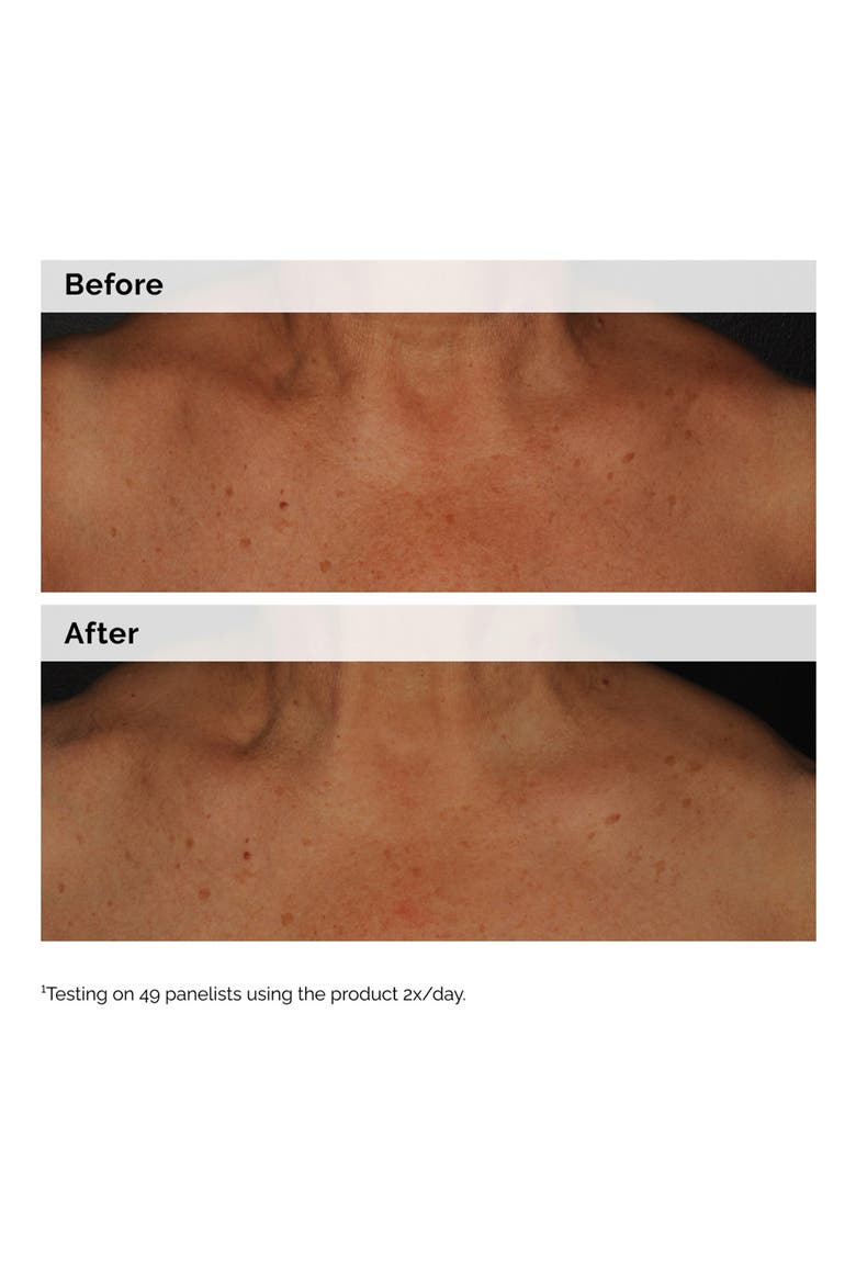 Salicylic Acid 0.5% Body Serum Exfoliating Treatment for Acne, Alternate, color, NO COLOR