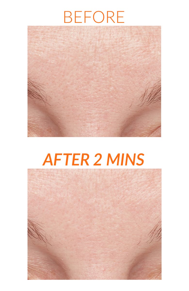 ExfoliKate<sup>®</sup> Intensive Exfoliating Treatment