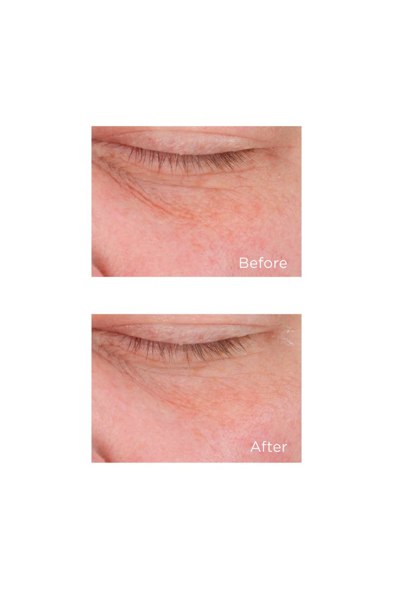 Cold Plasma+ Eye, Alternate, color, NO COLOR