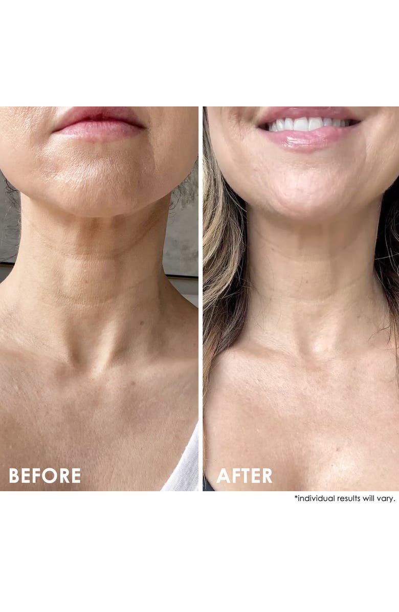 Dermelect SELF-ESTEEM Neck Firming Lift, Alternate, color, White